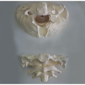 Giant Atlas Axis with Occipital Bone