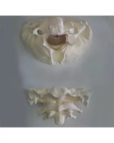 Giant Atlas Axis with Occipital Bone