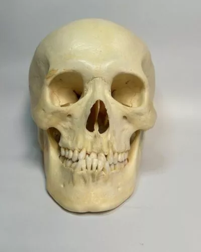 Male Skull with Severe Underbite