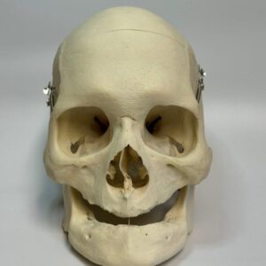 Edentulous Skull