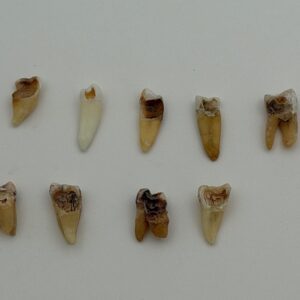 Real Human Tooth with Decay - Single