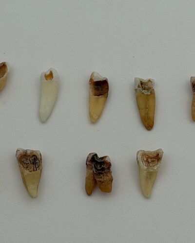 Real Human Tooth with Decay - Single