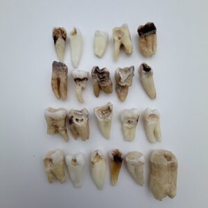 Real Human Tooth with Decay - Single