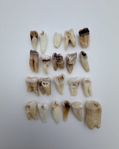 Real Human Tooth with Decay - Single